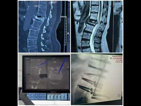 Can Paralysis be cured? Lumbar Spine slip disc treatment : Endoscopic Spine treatment