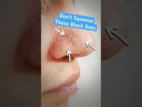 Don’t Squeeze Those Black Dots on Your Nose