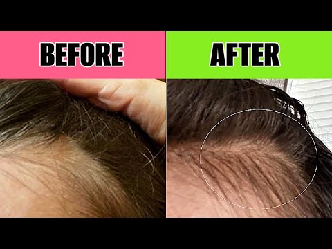 WHY YOU ARE LOOSING HAIR ? How to grow hair fast - naturally at home