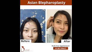 Blepharoplasty Before After | Before After of Eyelid Surgery