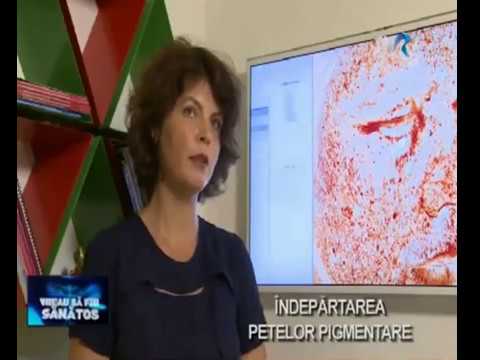 Indepartare pete pigmentare - dr. Andreea Iftimie - Clinica FAZZADA