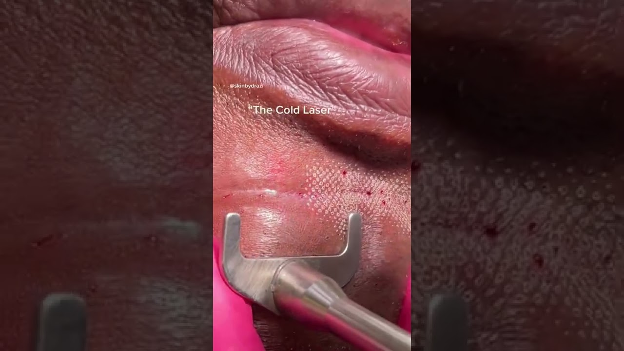 Watch Erbium Laser Resurfacing #shorts #shortsvideo Now Erbium Laser Resurfacing #shorts #shortsvideo