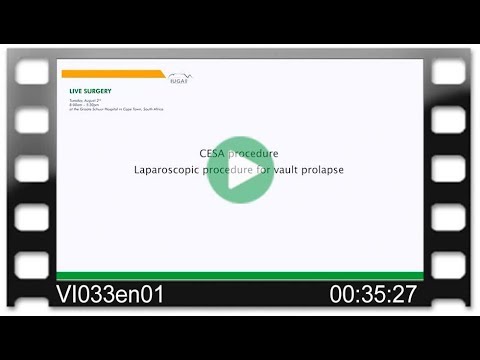 DynaMesh®-CESA - OR-Video: CESA procedure - Cervicosacropexy - Bilateral Fixation - Laparoscopy