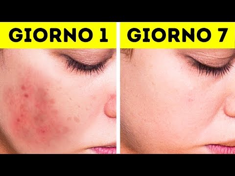 Come togliere posti di lentiggini La clinica per togliere posti di pigmentary