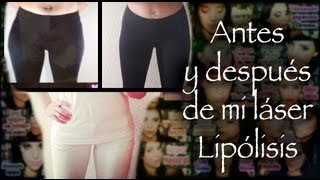 Antes y después de mi Láser Lipólisis | Silvia Quiros