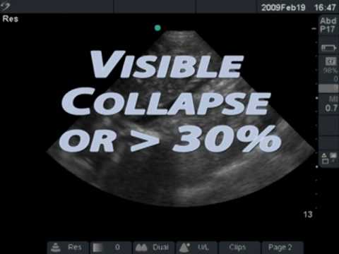 IVC Ultrasound for Fluid Responsiveness