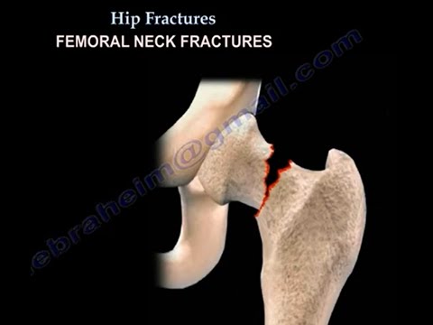 Hip Fractures types ,classification  and treatment