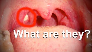 What Those Nasty White Chunks That Sometimes Come From Your Throat Are