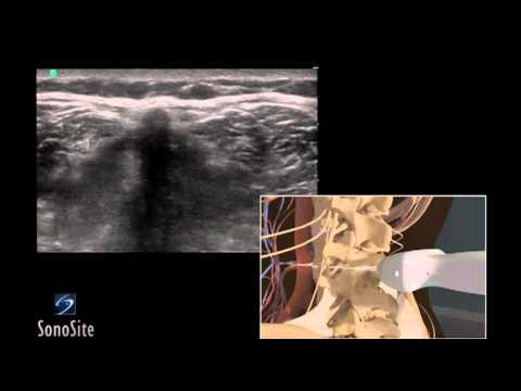 How To: Ultrasound Guided Lumbar Puncture Procedure 3D Video