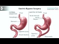 When Is Percutaneous Transhepatic Cholangiography Indicated For Jaundice Dr Naveen Kumar