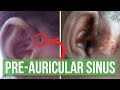 Explaining a preauricular sinus (a tiny hole in front of the ear) & what happens when it's infected