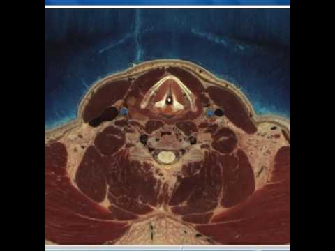 Virtual Dissection 11  The Larynx