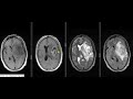 MRI Brain Grade III astrocytoma plain and with contrast