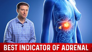 Dr.Berg Unfolds the Biggest Symptom of Adrenal Fatigue