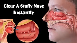 How to Get Rid of a Stuffy Nose Fast || 8 Home Remedies for Stuffy Nose During Pregnancy