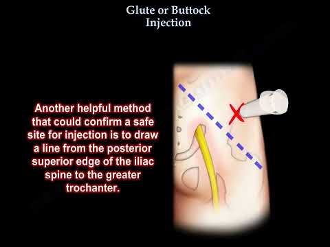 Técnica de inyección intramuscular en los glúteos