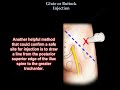 Glute Injection Buttock Injection