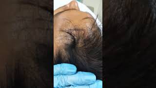 Scalp Micro Pigmentation SMP by El Truchan @ Perfect Definition