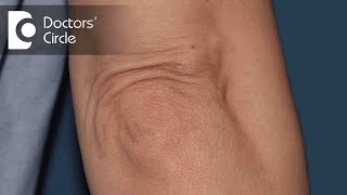 Is there a way to tighten up saggy elbows? - Dr. Ashok B C