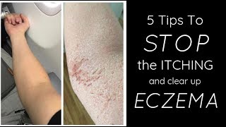 HEALING ECZEMA - 5 Things I Do Each Day To STOP THE ITCH