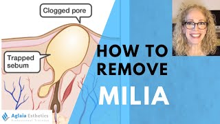HOW TO REMOVE A MILIA STEP BY STEP | NATURALLY