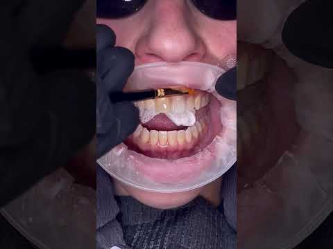 10 LUX NO PREP VENEERS - CHANGING WHATS POSSIBLE!🤩No shaving, no drilling, NO PAIN!  #noprepveneers