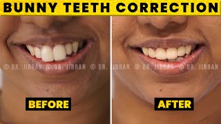 Bunny Teeth Correction by Dr. Jibran | Smile Correction in Chennai