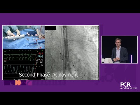 Optimising TAVI for bicuspid aortic stenosis: experience with a novel self-expanding system