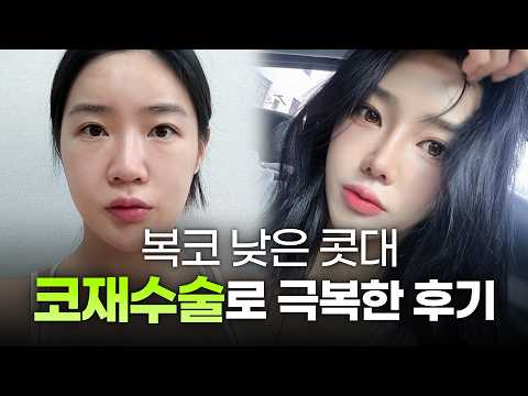 화려한 광고 안 믿고 독하게 코재수술병원발품 팔아서 내 인생 최고의 원장님 만났습니다! ㅣ디에이성형외과ㅣ뭉툭한복코재수술