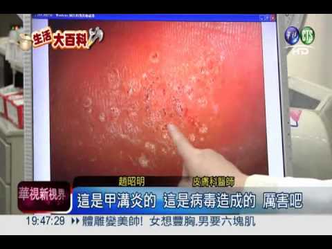 磨腳皮當心! 器具消毒不慎恐爛腳