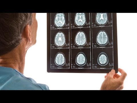 Anzeichen und Symptome von Epilepsie | Epilepsie