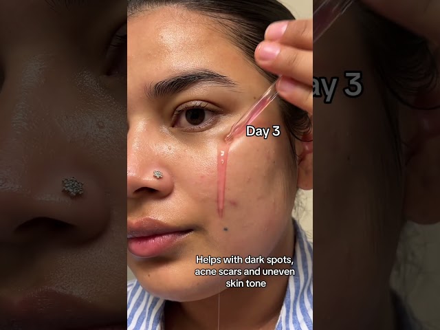 Vídeo relacionado con ANUA Niacinamide 10 + TXA 4 Serum, Hyaluronic Acid, Tranexamic acid, Vitamin B12, Facial Serum for Glass Skin, Clarifying, Radiant Complexion with Natural Color, Korean Skin Care (30ml /1.01 fl.oz)