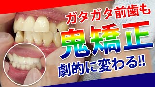 【セラミック矯正】ガチ変身！ガタガタ前歯を即日治療サムネイル