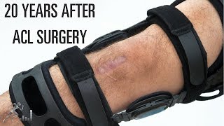 Whatisthefutureofmyknee20yearsafterACLsurgery?