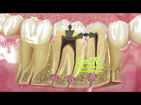 DentTV presenta: Las caries y la restauranción dental
