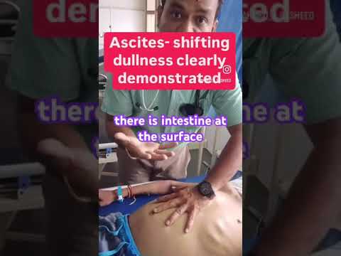 Shifting Dullness for Ascites