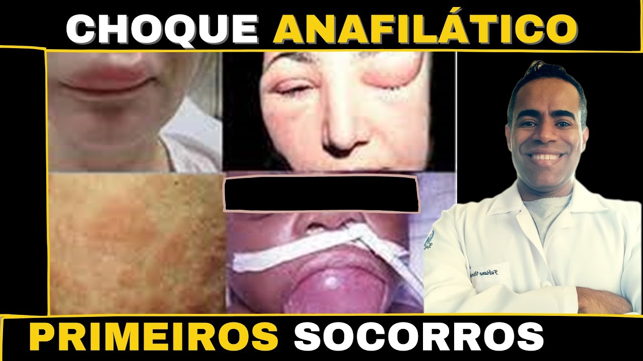 Choque anafilático primeiros socorros e os cuidados de enfermagem