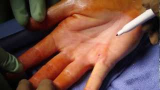 Dupuytren's Contracture - W. Alan Ward, MD