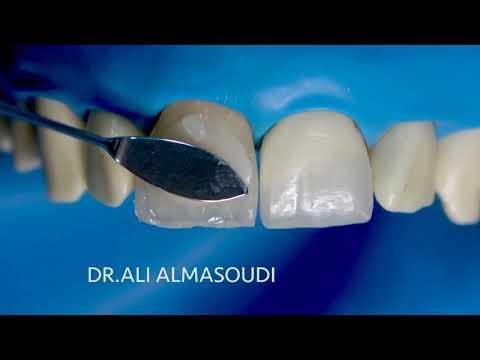 Direct composite with SOLO Anterior