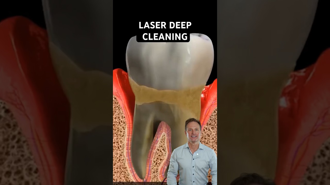 Laser deep cleaning for gum disease (periodontal disease) #dentalhygiene #dentist
