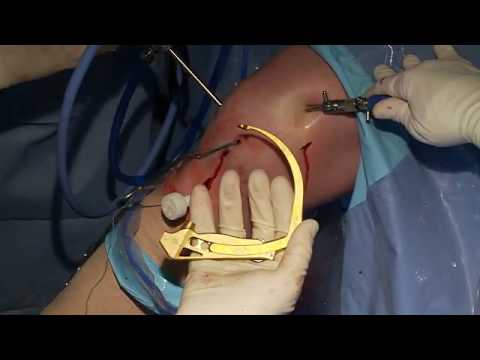 Knee Dislocation: ACL Reconstruction - PCL Reconstruction