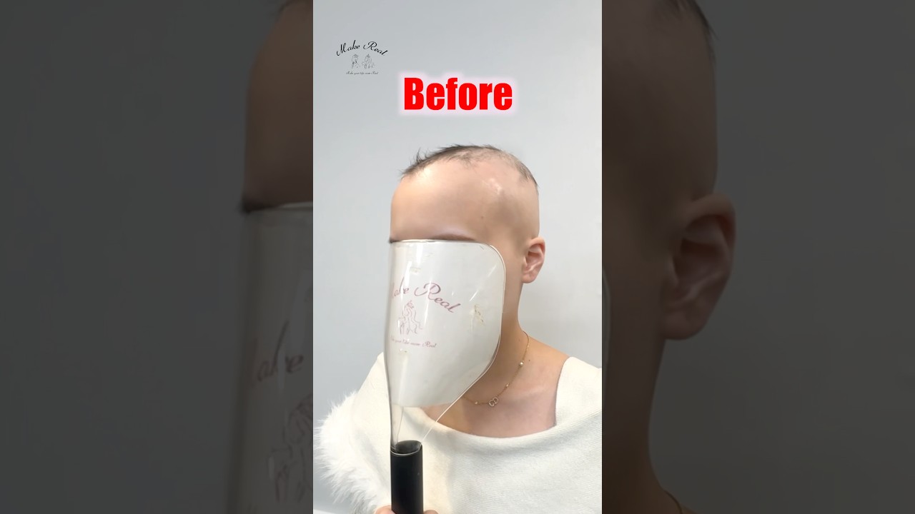 20代脱毛症の女の子にとって心地いい自分がこれ。#ウィッグ #脱毛症 #alopecia #가발 #wig