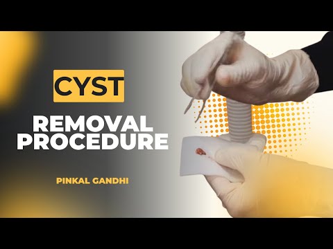 Cyst Removal Procedure