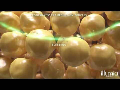 Onda Coolwaves Slim Science by Illumia Therapeutics