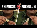 Ling Ki Tight Chamdi Or Seal Phimosis Vs Tight Frenulum Hindi
