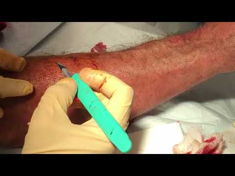Kung ito ay posible na mag-aplay ekzoderil panahon ng pagpapakain Trihopol halamang-singaw cures