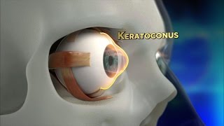 Keratoconus Procedure Explained