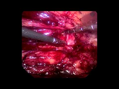 Laparoscopic Idiopathic Retroperitoneal Fiibrosis (IRPF)