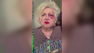 Il video di Wanna Marchi con i lividi sul viso e sulle mani: «Un incidente mentre stavo passeggia...