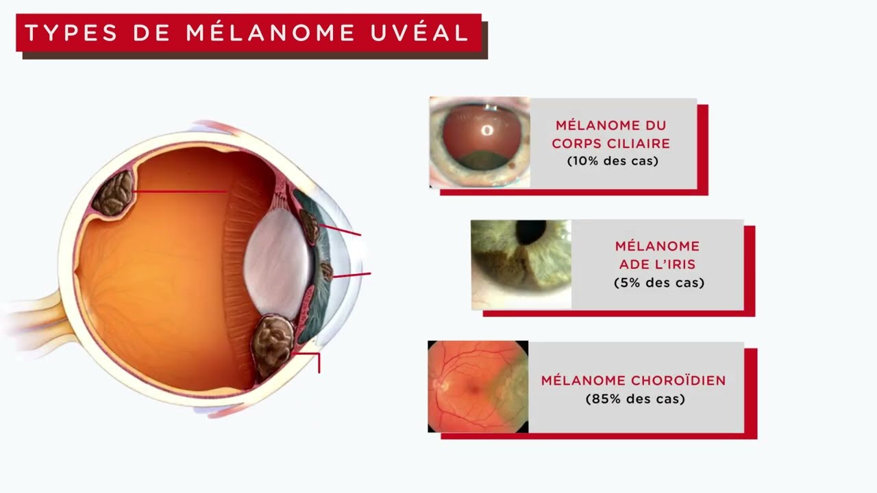 Mieux Comprendre Le Mélanome de L'uvée: Guide  à L'Intention Des Patients